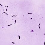 us-tuberculosis-cases-were-at-the-highest-level-in-a-decade-in-2023