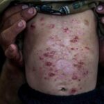 lice,-scabies,-rashes-plague-palestinian-children-as-skin-disease-runs-rampant-in-gaza’s-tent-camps