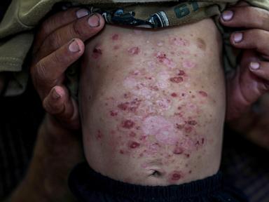lice,-scabies,-rashes-plague-palestinian-children-as-skin-disease-runs-rampant-in-gaza’s-tent-camps