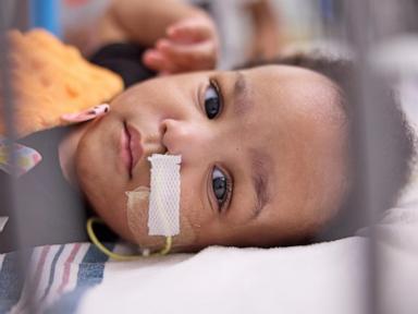 twin-boys-born-conjoined-celebrate-1st-birthday-after-separation-surgery