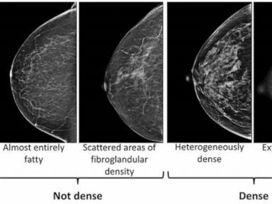 dense-breasts-can-make-it-harder-to-spot-cancer-on-a-mammogram