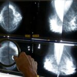 some-breast-cancer-patients-can-avoid-certain-surgeries,-studies-suggest