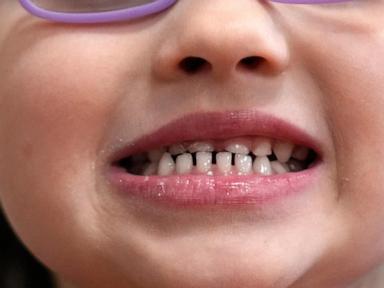 fda-and-rfk-jr.-aim-to-remove-fluoride-supplements-used-to-protect-kids’-teeth