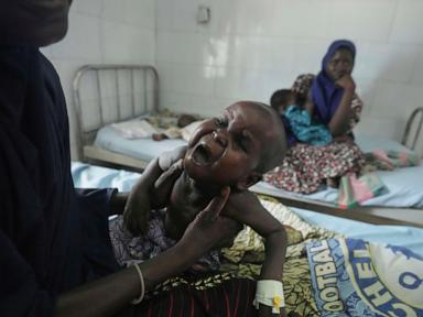 children-die-as-usaid-aid-cuts-snap-a-lifeline-for-the-world’s-most-malnourished