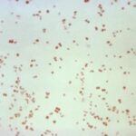 sexually-transmitted-disease-cases-fall,-but-not-syphilis-in-newborns