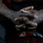 congo-says-its-mpox-outbreak-is-over-after-2-years-and-more-than-2,200-suspected-deaths