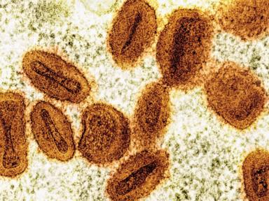 scientists-charged-with-bringing-deactivated-mpox-virus-into-us,-lying-to-authorities