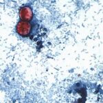 15-states-now-linked-to-iceberg-lettuce-cyclospora-outbreak,-cdc-says