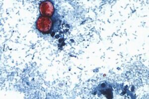 15-states-now-linked-to-iceberg-lettuce-cyclospora-outbreak,-cdc-says